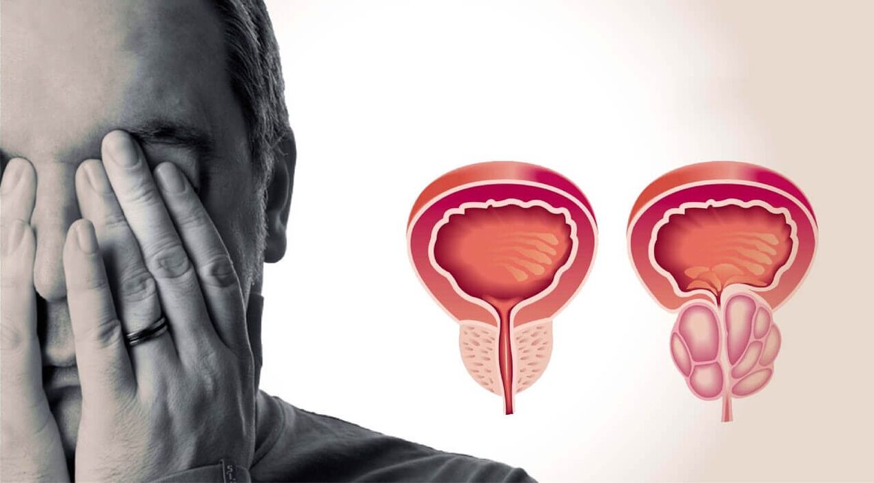 Zdravá a boľavá prostata u mužov